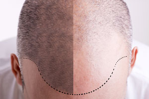 FUE, czyli Follicular Unit Excision