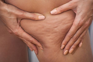 Drugi stopień zaawansowania cellulitu